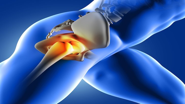 Hip Pain from Car Accident - David Azizi